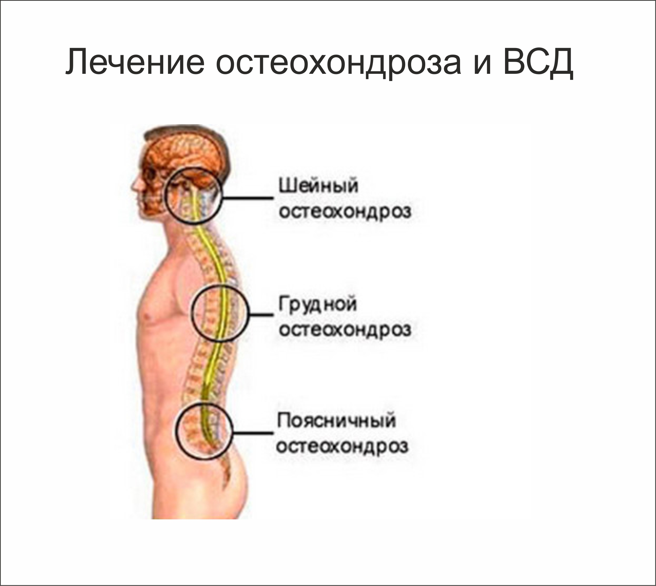 Остеохондроз шейного грудного Остеохондроз шейного грудного